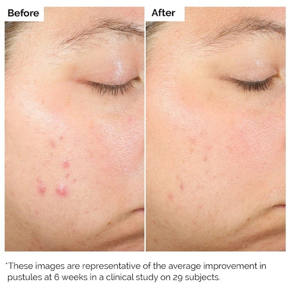 The OrdinaryâSalicylic Acid 2% Exfoliating Solution (30mL) *NIB* - Picture 5 of 6